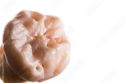 Third molar with a extrange morphology