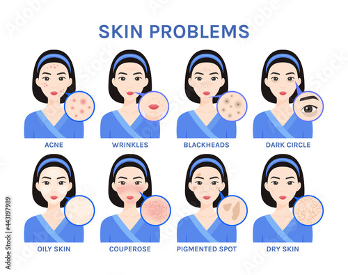 Skin Problems on the Beautiful Face of Asian Girl close-up. Acne, Rosacea, Pigmented Spots, Dark circles, Dry and Oily skin, Wrinkles. Flat color cartoon style. White background. Vector illustration.
