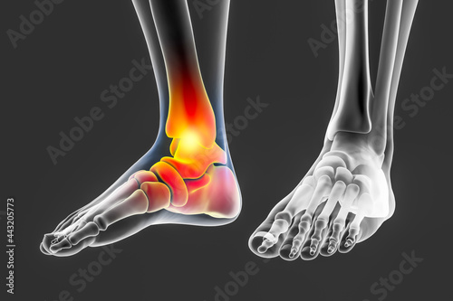 Foot and ankle pain, conceptual 3D illustration