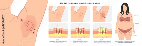 boil cyst acne swollen cancer ingrown hair skin pain lump armpit groin buttock breast tract sinus leak pus Excess weight stress change cancer genes women lymph thigh scar pitted Sores node body Anus