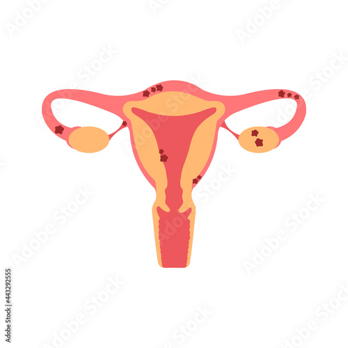Uterus with endometriosis flat illustration. Fertility, human anatomy, female reproductive system. Disease, gynecology, inflammation.
Outside tissue growth medical condition 
