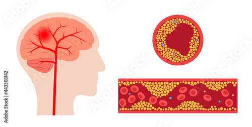 Brain stroke ishemic