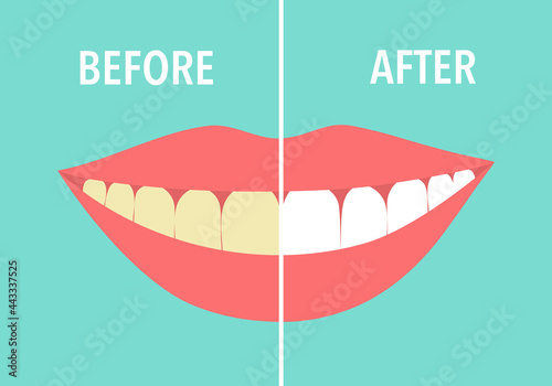 Woman smiling lips with dirty and white teeth compared in flat design. Before and after dental treatment. Oral care.