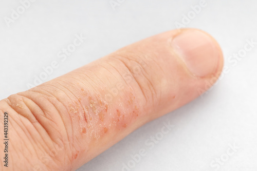 Close up of Eczema on finger. Skin disease