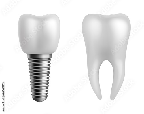 Dental implant and teeth. Realistic orthodontic elements. Human white enamel tooth crown, dentistry implantation technology, stomatology clinic object, vector 3d isolated illustration