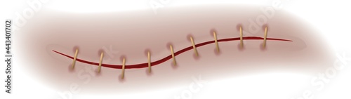 Scar or wound. Realistic bloody stitch. Surgical sutures healing seam closeup texture, human body medical curing steps operation, injury and disability vector isolated illustration