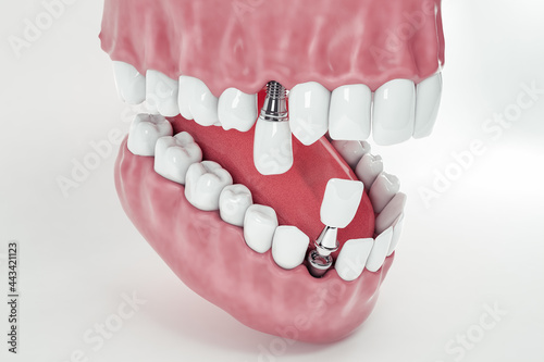 Detail of a false tooth implant fixed in the jaw