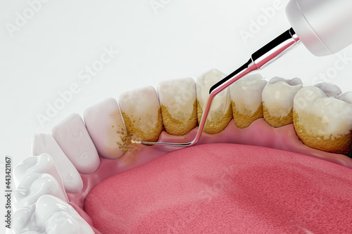 Dental cleaning removing plaque photo