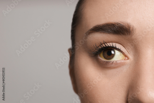 Woman with yellow eyes on grey background, closeup and space for text. Liver problems symptom photo