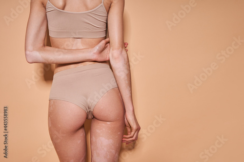 Girl with vitiligo disorder is showing her back while posing at the studio