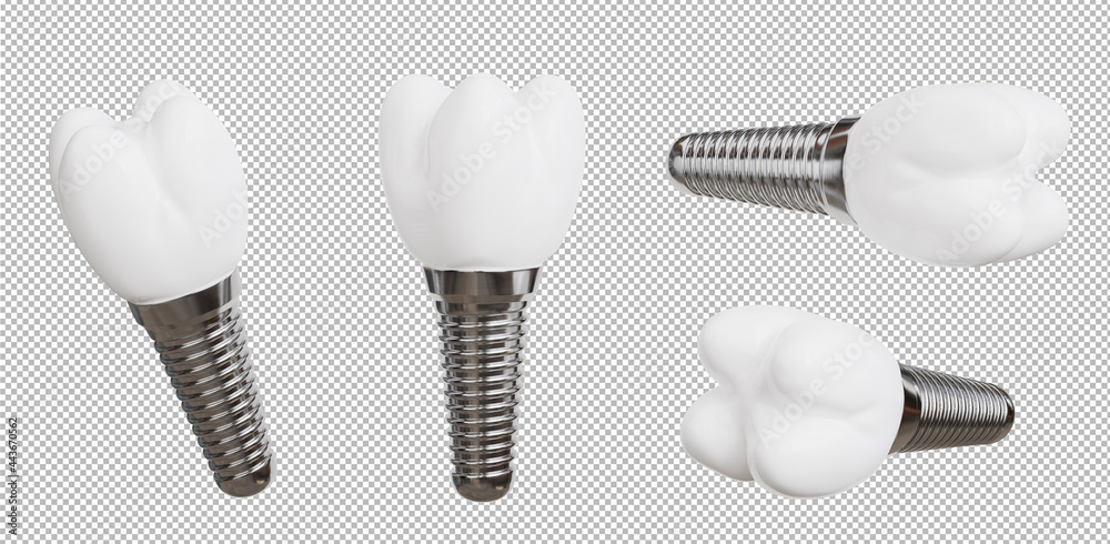 3d render of dental implant collection on transparent background,with