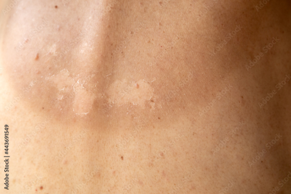 Burnt skin, birthmarks and texture. Beauty and health