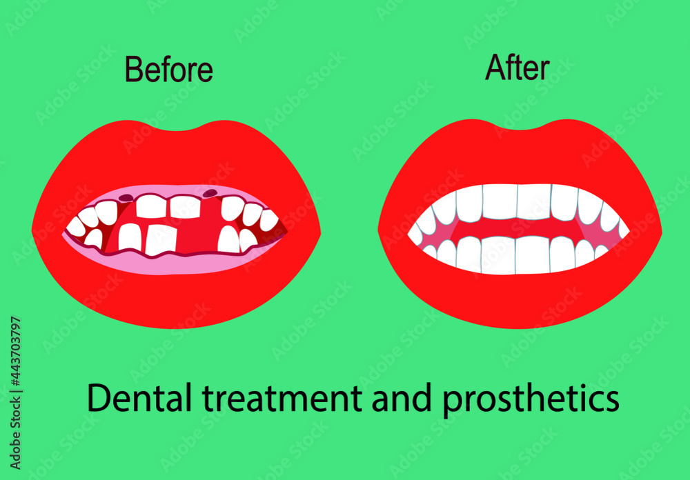 Dental treatment and prosthetics graphic flat illustration. Dentistry and Orthodontics. Teeth before and after the doctor's treatment.The mouth is open Dental treatment and prosthetics graphic flat illustration. Dentistry and Orthodontics. Teeth before and after the doctor's treatment.The mouth is open