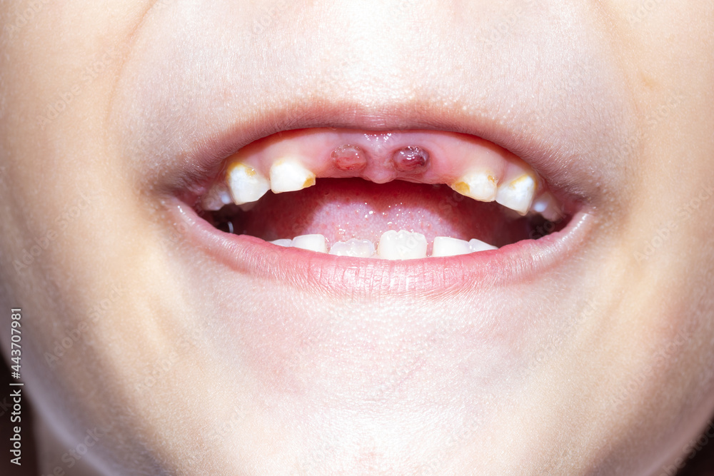 A 5yearold boy whose upper milk tooth incisor fell out. Kid patient