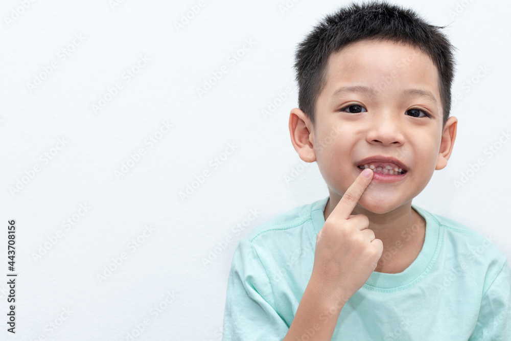 Asian little boy was pointing at his permanent teeth are growing. A 5-year-old boy whose upper milk tooth incisor fell out. Kid happy open mouth showing cavities teeth decay. Asian little boy was pointing at his permanent teeth are growing. A 5-year-old boy whose upper milk tooth incisor fell out. Kid happy open mouth showing cavities teeth decay.