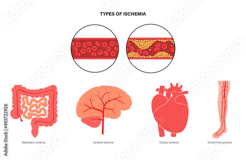 Types of ishemia photo