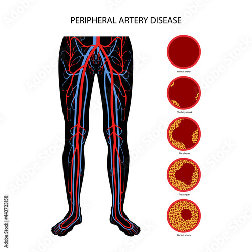 Peripheral artery disease