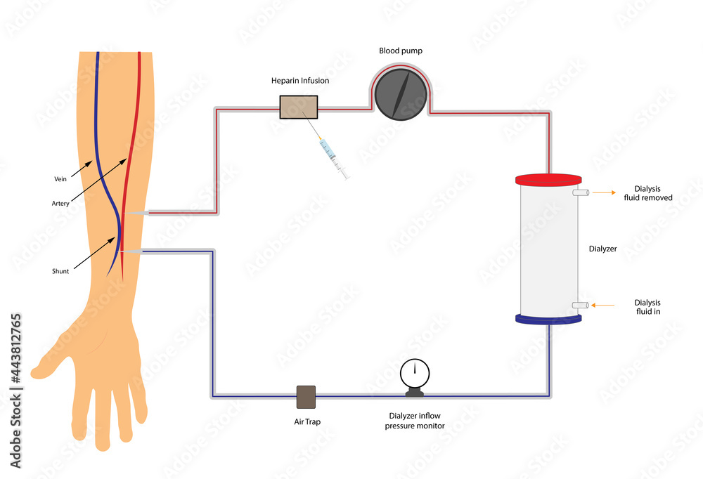 Hemodialysis procedure. Blood filtration and return to the patient arm