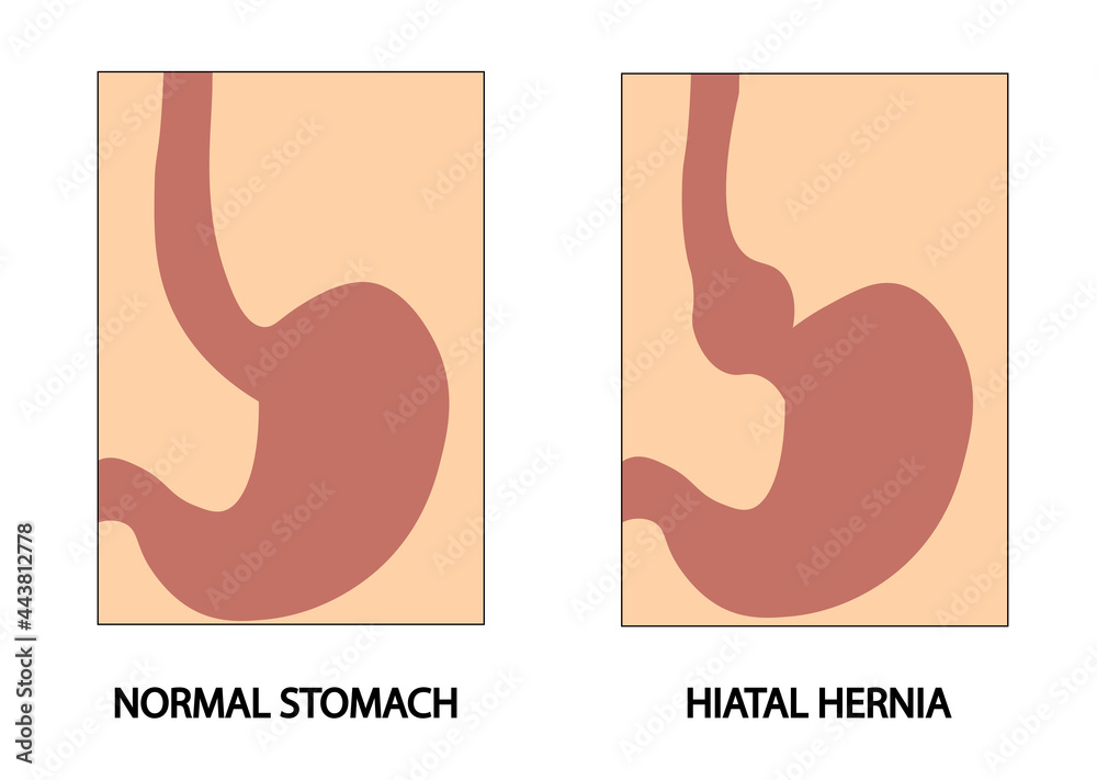 Hiatus hernia. Hiatal hernia. Types of hiatal hernia illustration Stock