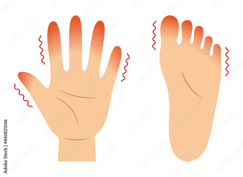 赤く腫れた指先 指先のしもやけと凍傷 手と足 Stock Vector Adobe Stock 赤く腫れた指先 指先のしもやけと凍傷 手と足 Stock Vector Adobe Stock