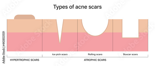 Types of acne scars vector.  Acne scar analysis
