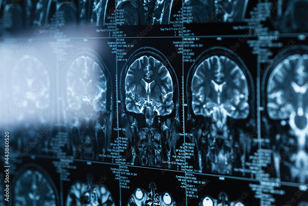 series of MRI images of head and brain, magnetic resonance imaging scan ...