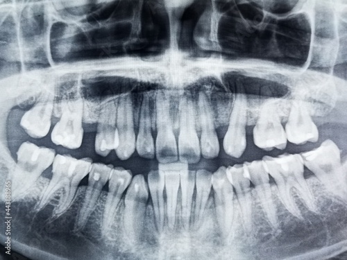 Medical x-ray of teeth