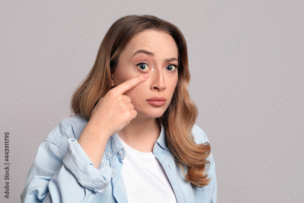 Woman with yellow eyes on grey background. Liver problems symptom Woman with yellow eyes on grey background. Liver problems symptom