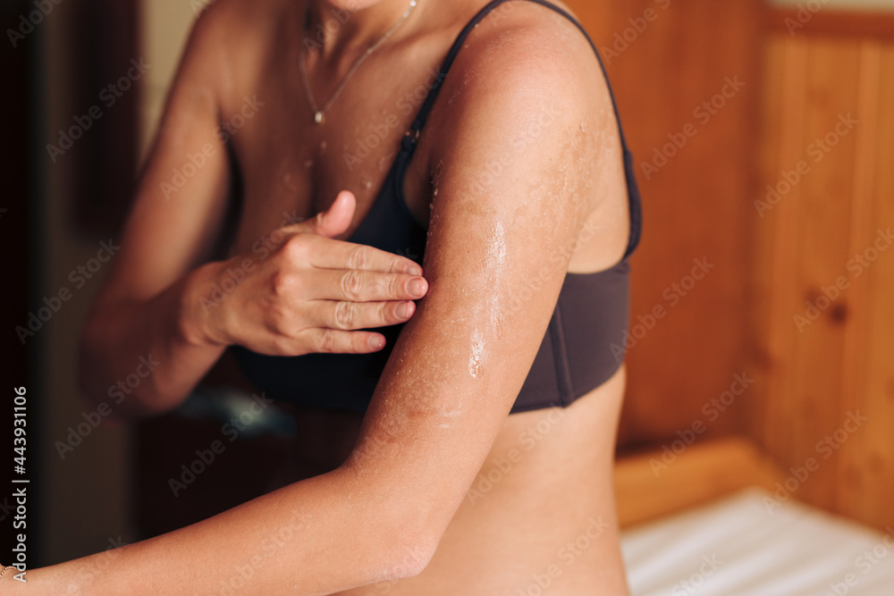 © Lucas Ottone/Stocksy - Damaged sunburnt skin