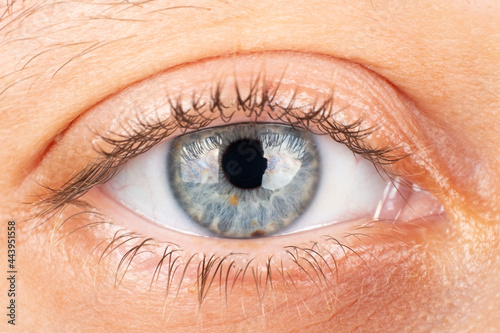 beautiful female eye, diagnosis of keratoconus corneal dystrophy
