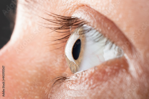 woman eye closeup with 3 stage of keratoconus, corneal dystrophy