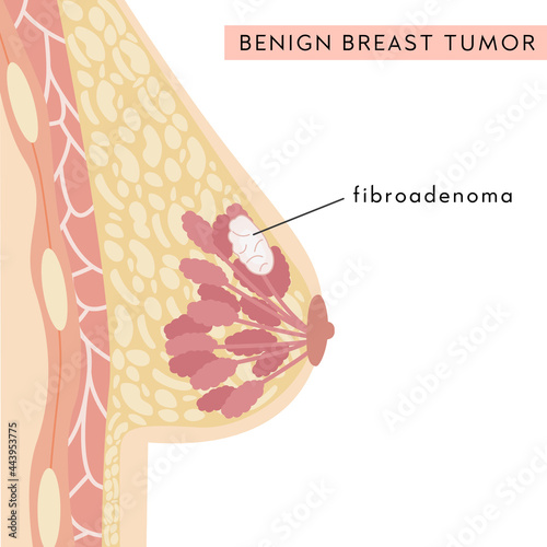 Medical Infographic Cross Section of Female Breast with Fibroadenoma. Information card with benign breast lesion. Anatomy of Woman Chest. Mammary gland with non cancerous tumor. Vector illustration.