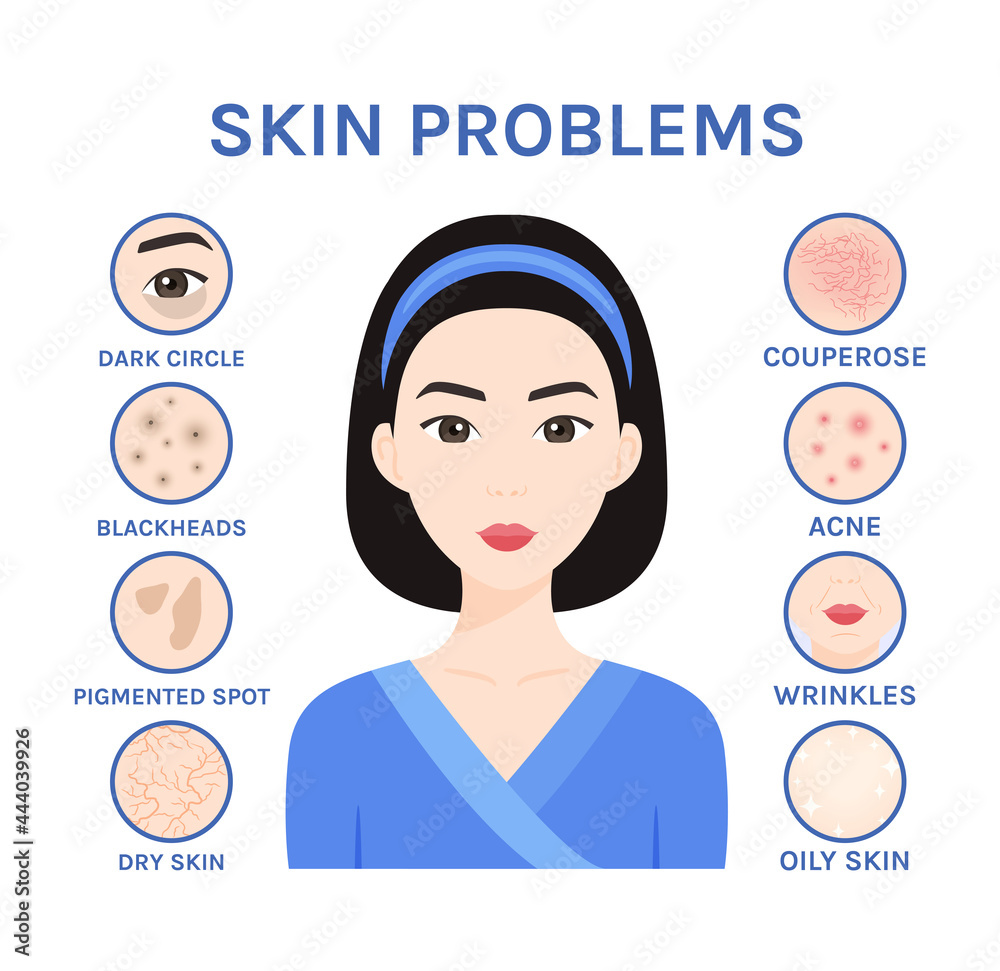 Skin problems. Isolated Asian Woman and Care, Treatment. Korean Girl has Acne, Black Dots, Wrinkles, Dark Circles, Dry and Oily Skin. Illustration for Beauty and Medical Design. Cartoon style. Vector Stock Vector | Skin problems. Isolated Asian Woman and Care, Treatment. Korean Girl has Acne, Black Dots, Wrinkles, Dark Circles, Dry and Oily Skin. Illustration for Beauty and Medical Design. Cartoon style. Vector Stock Vector |