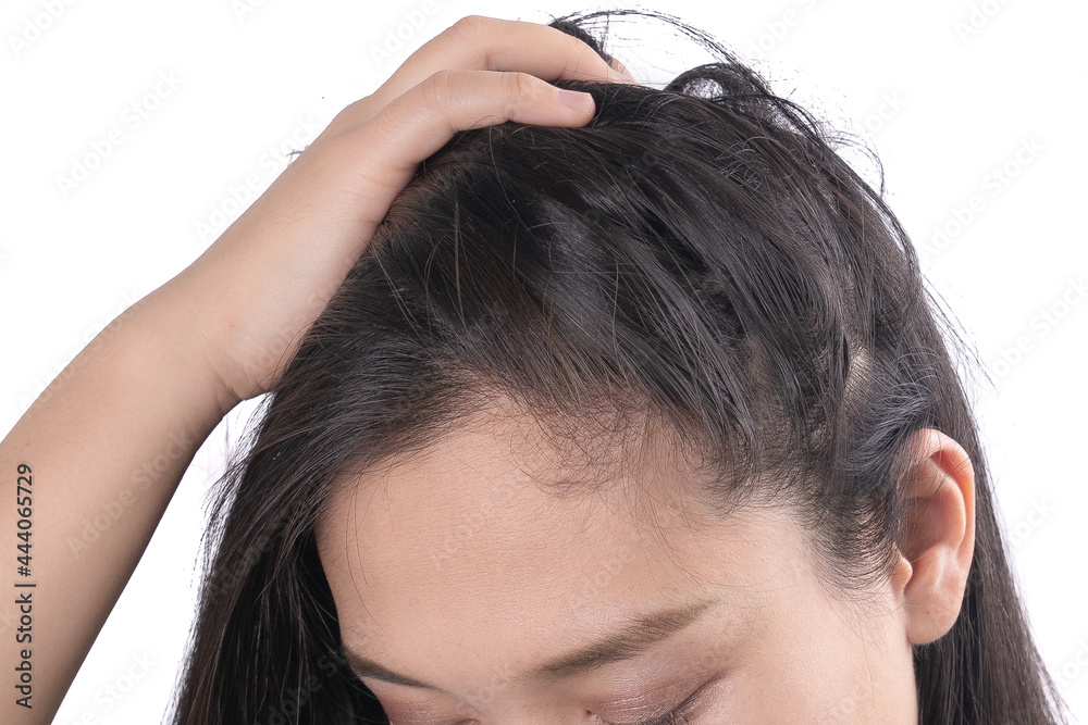 Young Asian women worry about problem hair loss,head bald,dandruff.hair loss problem and Hair treatment concept Young Asian women worry about problem hair loss,head bald,dandruff.hair loss problem and Hair treatment concept
