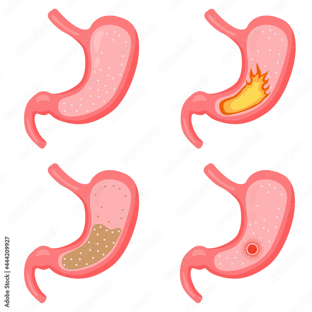 Fototapeta premium stomach healthy stomach sick set 2 dd ww