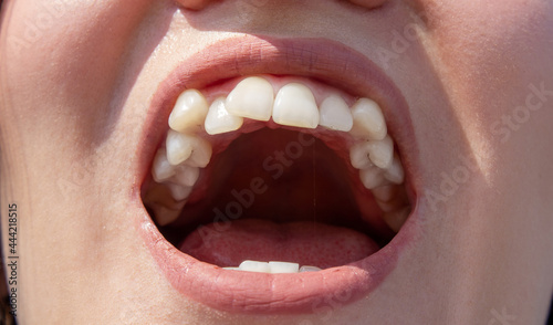 Photos Curved female teeth, before installing braces