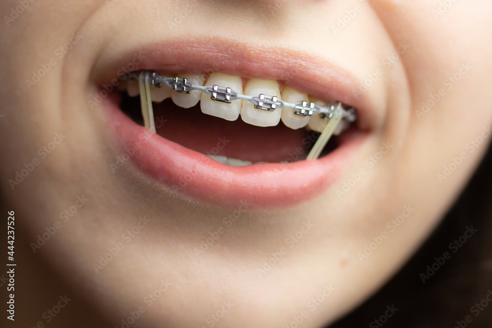 Closeup of a woman with braces wearing power chains and orthodontic  elastics to correct her bite. Stock Photo | Adobe Stock