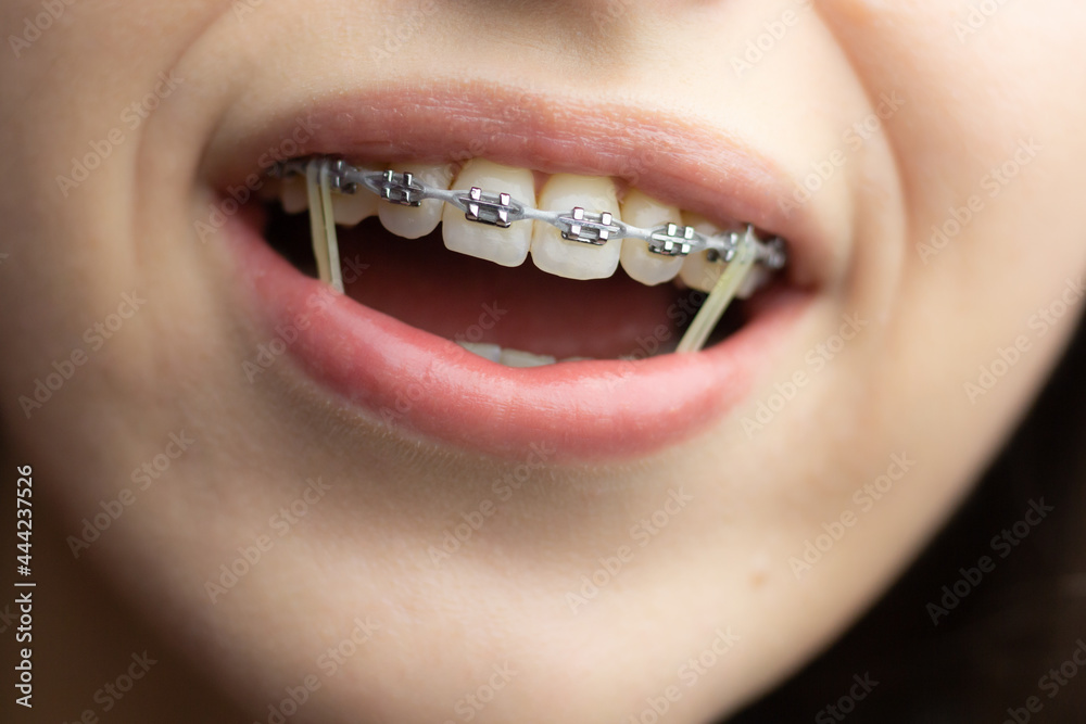 Closeup of a woman with braces wearing power chains and orthodontic elastics to correct her bite.