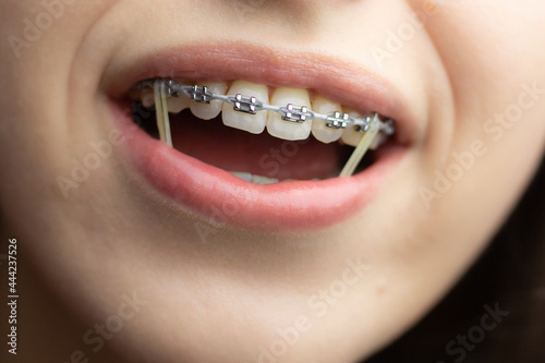 Closeup of a woman with braces wearing power chains and orthodontic elastics to correct her bite.