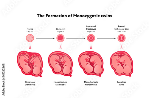 Embryo in womb medical diagram. Vector flat healthcare illustration. Formation of monozygotic twins. Design for health care, education. photo