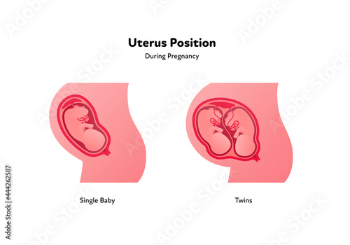 Embryo in womb medical diagram. Vector flat healthcare illustration. Uterus position during pregnancy. Single baby and twins. Design for health care, education. photo