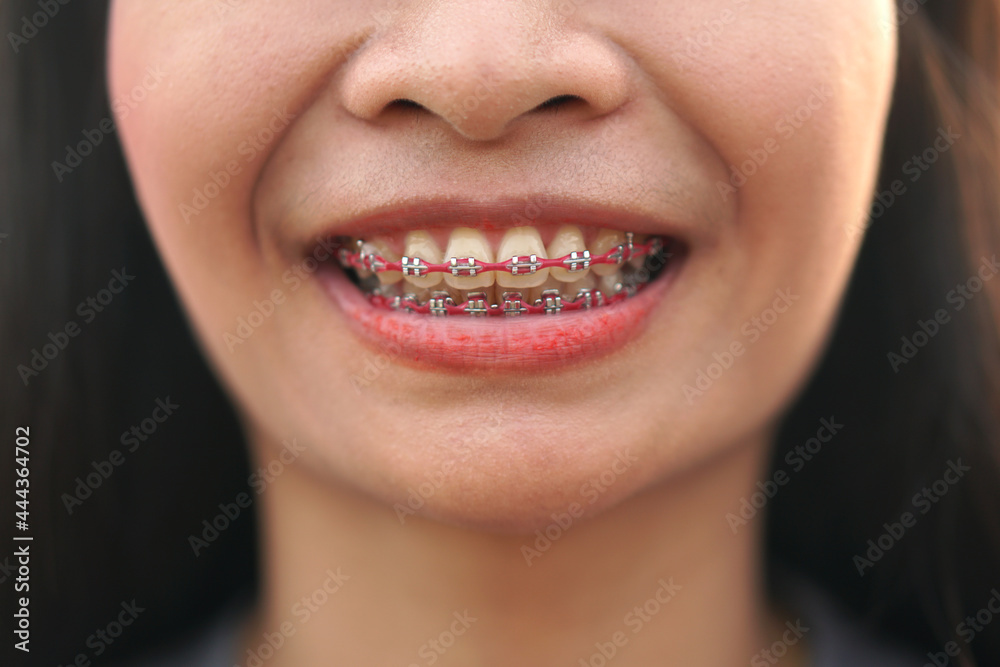 smiling asian woman I orthodontic. Detail of young womans smile showing white teeth with braces. smiling asian woman I orthodontic. Detail of young womans smile showing white teeth with braces.