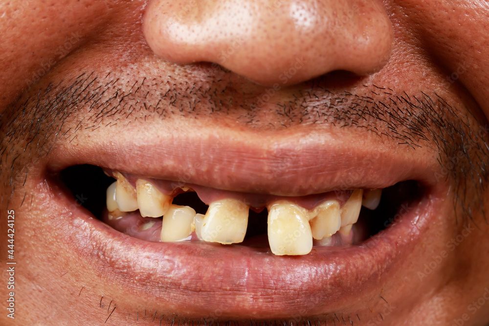 Obraz premium A man have oral health problems from smoking