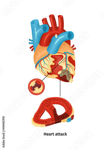 Heart Attack Poster