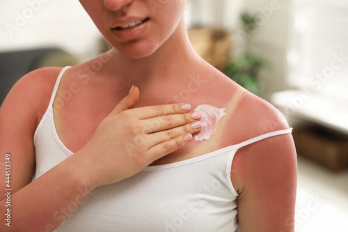 Woman applying cream on sunburn at home, closeup photo