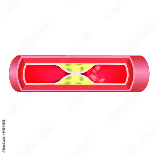 The structure of the human artery. The formation of fatty plaques and blood clots. Violation of blood circulation. Vienna in longitudinal section. Vector illustration