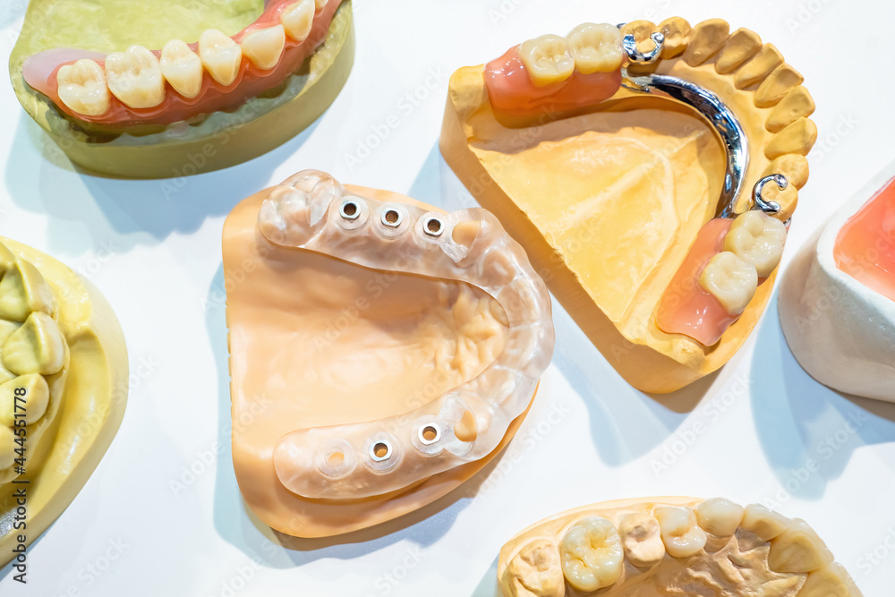 Prosthetic human jaws. Dental prosthetics. Dentures with plastic and