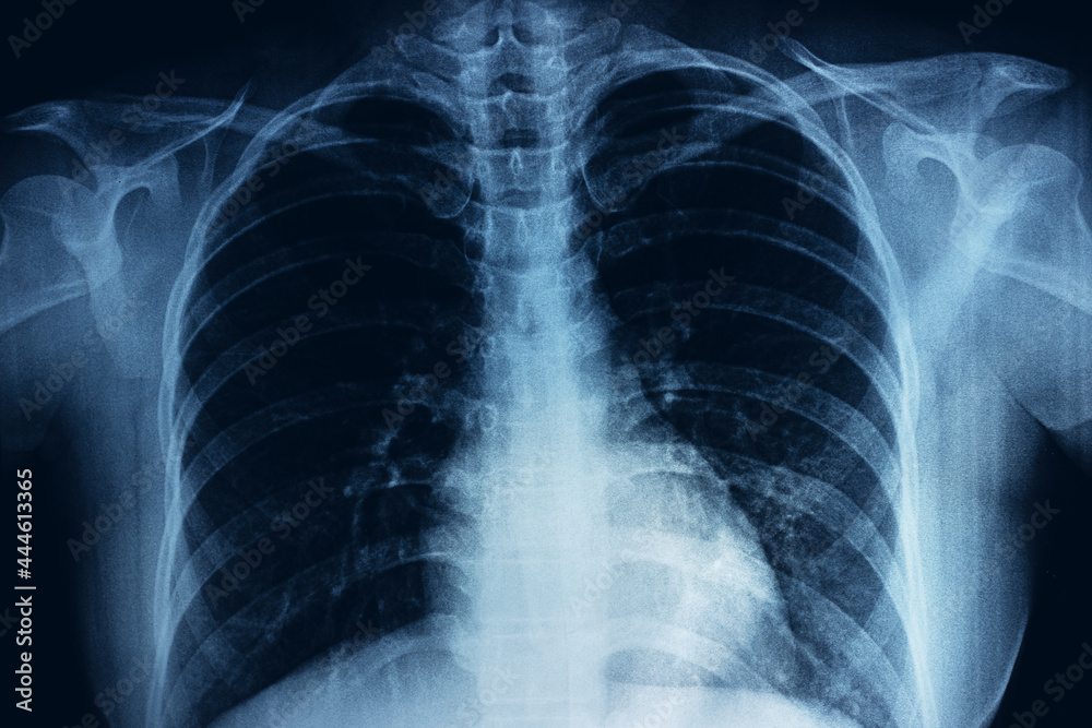 Film X-ray of breast