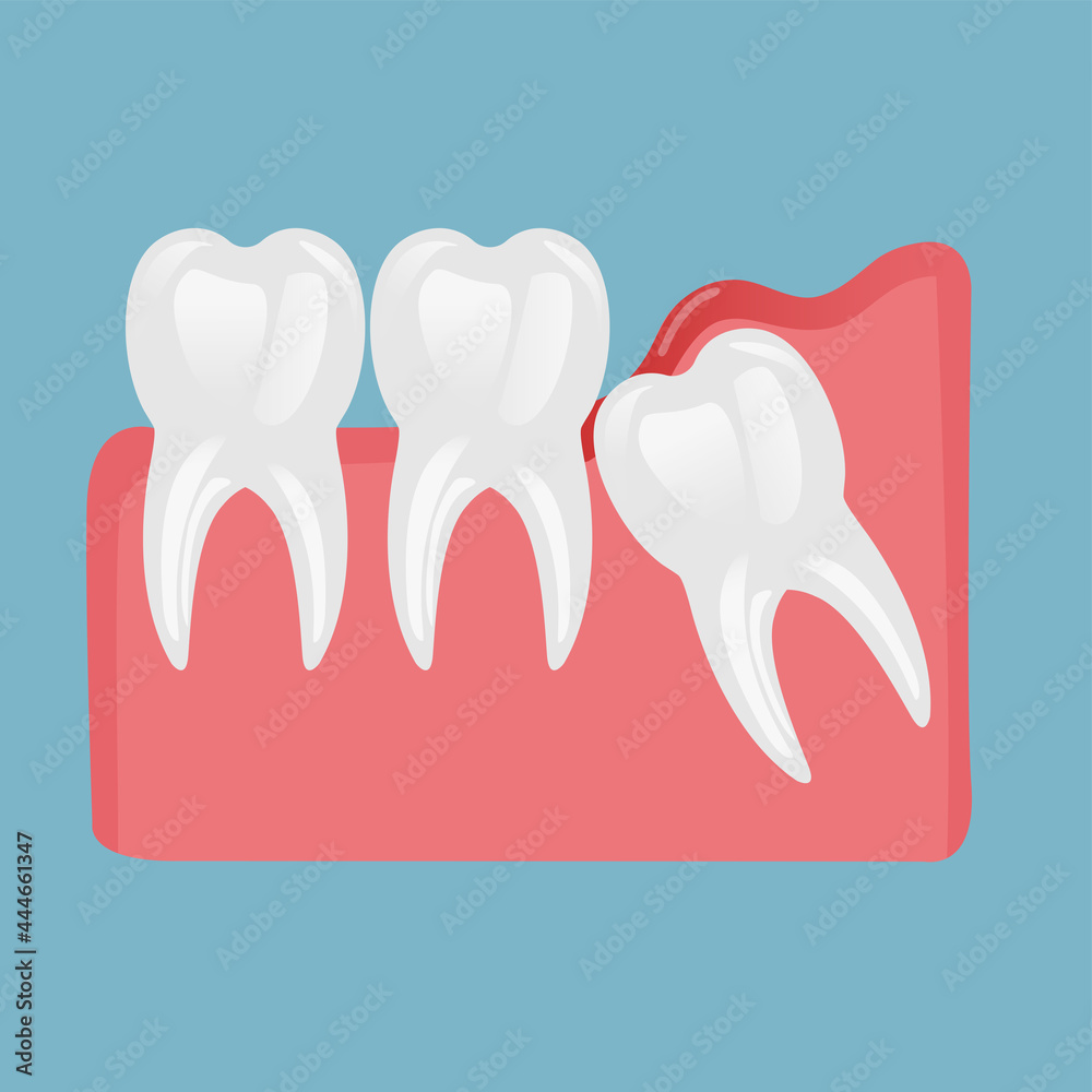 a molar tooth comes out of the gum and two healthy teeth