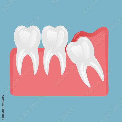 a molar tooth comes out of the gum and two healthy teeth